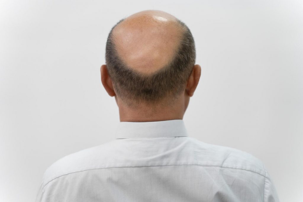 How To Regrow Hair On Bald Spot Home Remedies And Treatments 