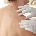 How To Remove Black Spots On Back And Neck