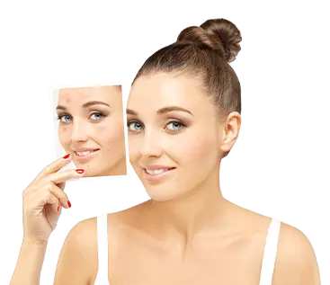 Acne Scar Removal Treatment in Hyderabad, Chennai & Bangalore